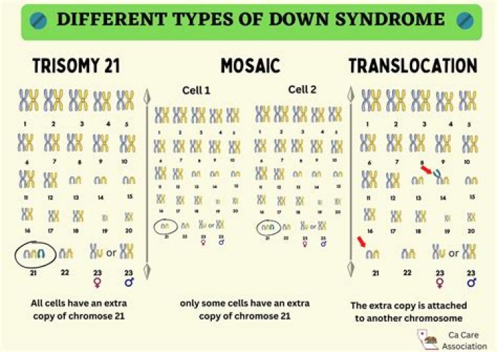 Are there different levels of severity of Down syndrome?