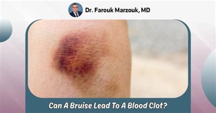 Can a bruise calcify?
