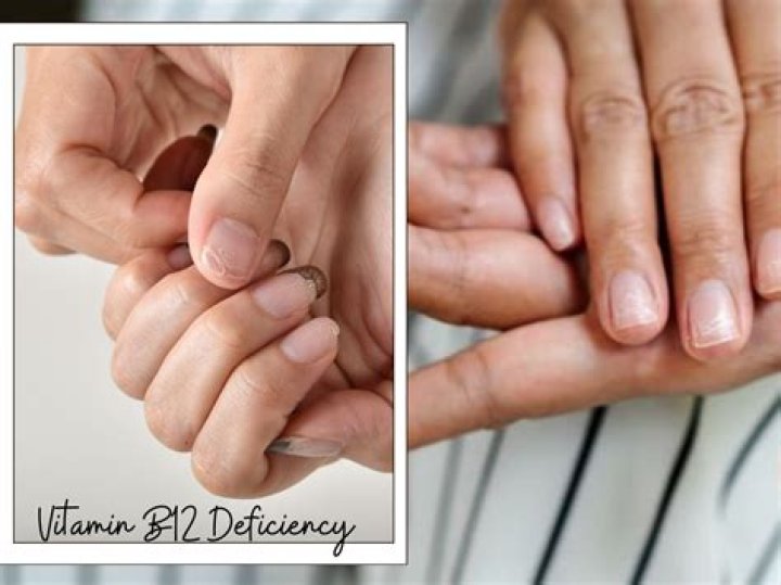 Can b12 deficiency affect your nails?