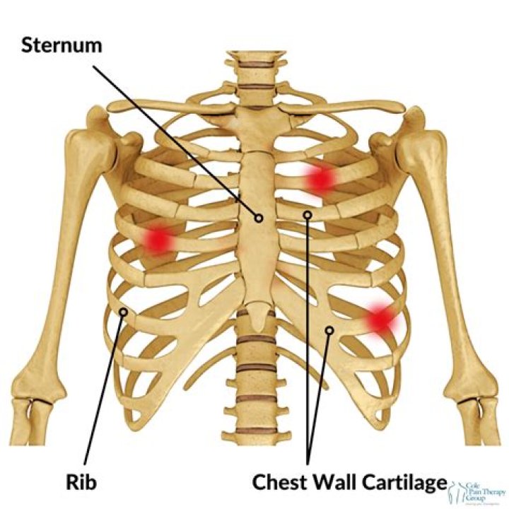 Can costochondritis feel like heartburn?