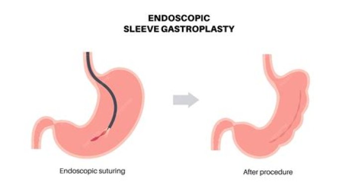 Can laparoscopy cause weight loss?