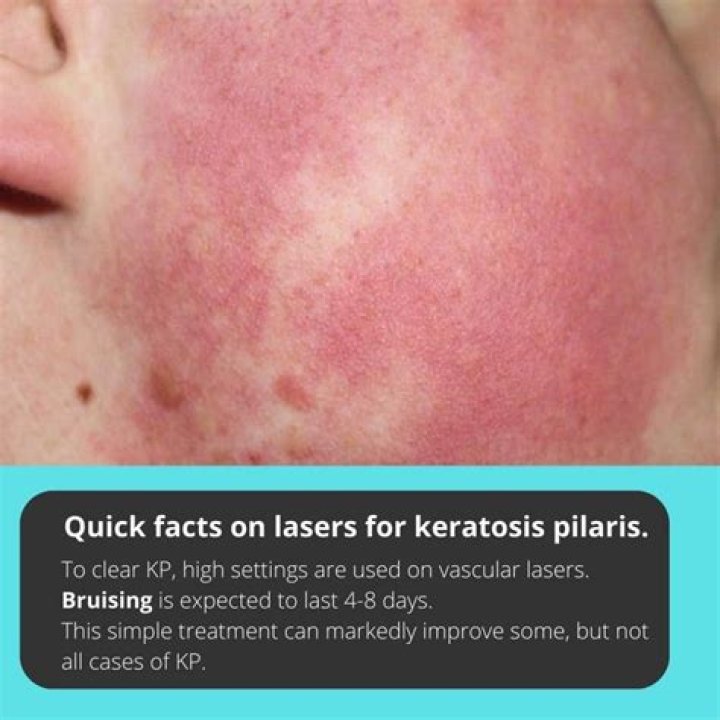 Can laser treat keratosis pilaris?
