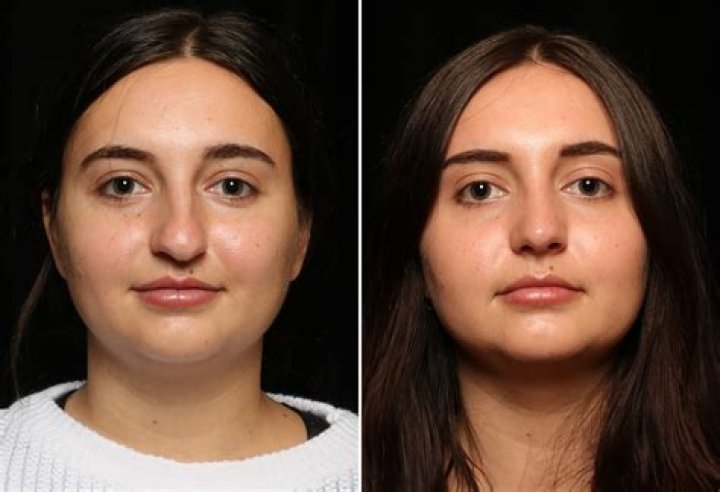 Can rhinoplasty change your face?