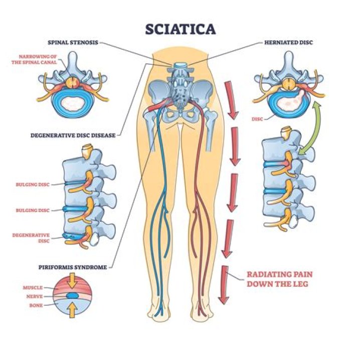 Can sciatica affect the brain?