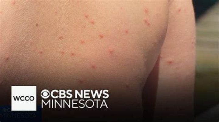 Can swimmer's itch appear a week later?