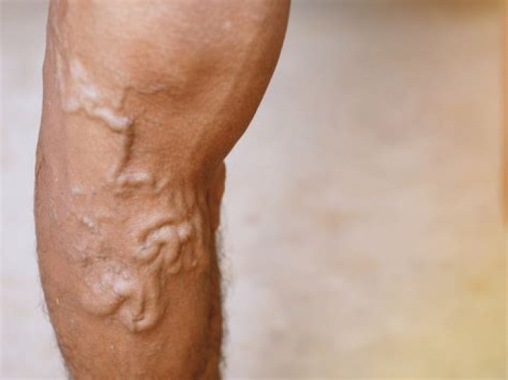 Can veins get twisted?