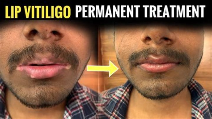 Can vitiligo on lips be cured?
