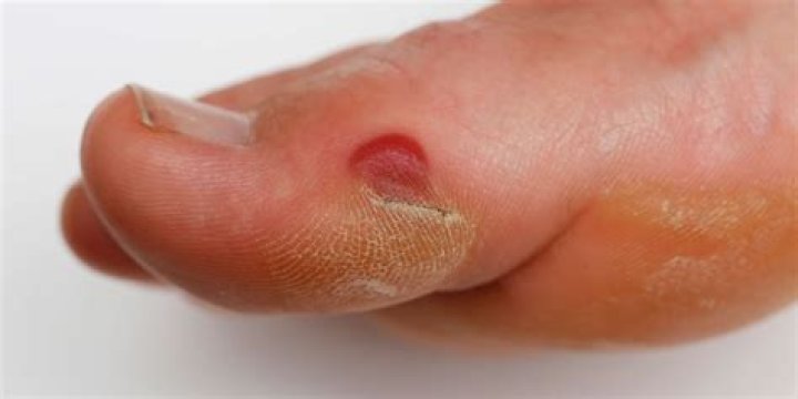 Can you get a blood blister under a callus?