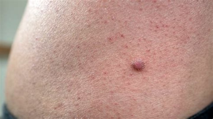 Can you remove a Dermatofibroma?