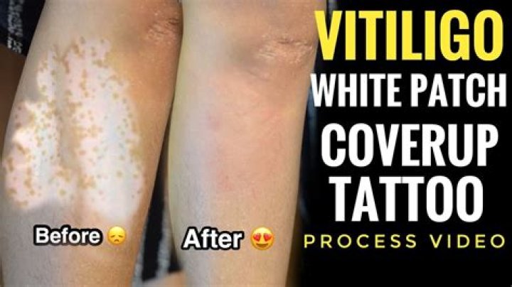 Can you tattoo over vitiligo?
