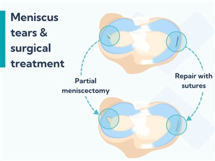 Can you tear your teres minor?