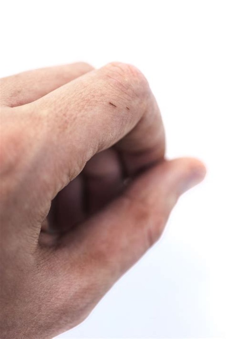 Do splinters go away?