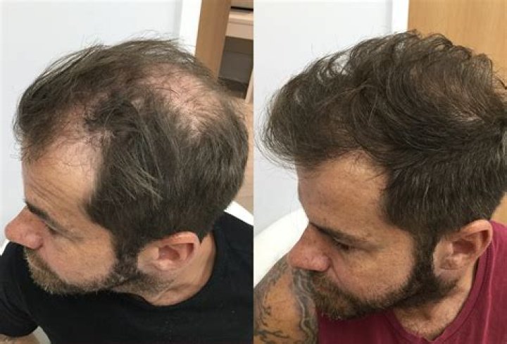 Does hair grow back after stopping minoxidil?