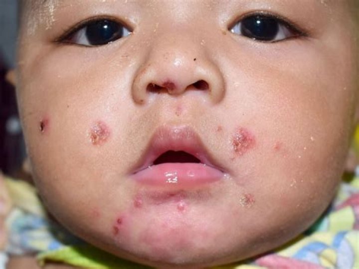 Does impetigo have pus?