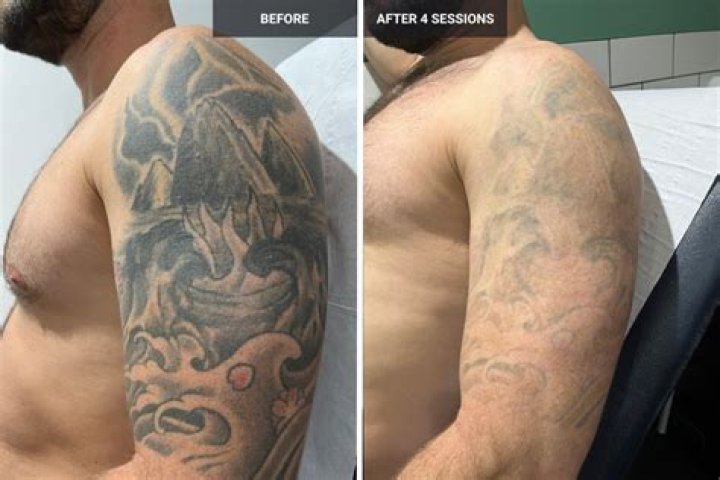 Does laser tattoo removal really work?