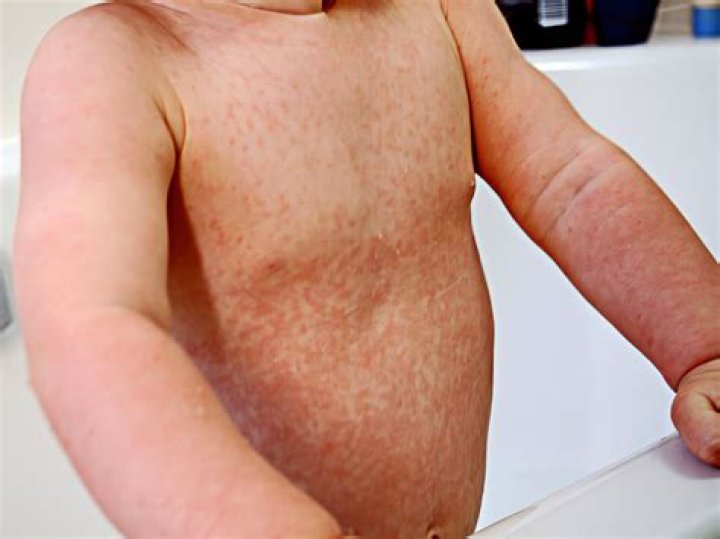 Does rubella have Koplik spots?