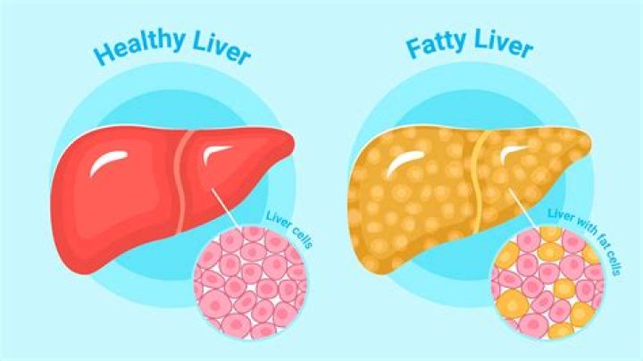 How can I heal my fatty liver?