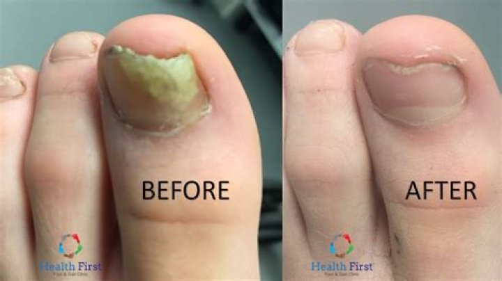 How can I treat toenail fungus at home?