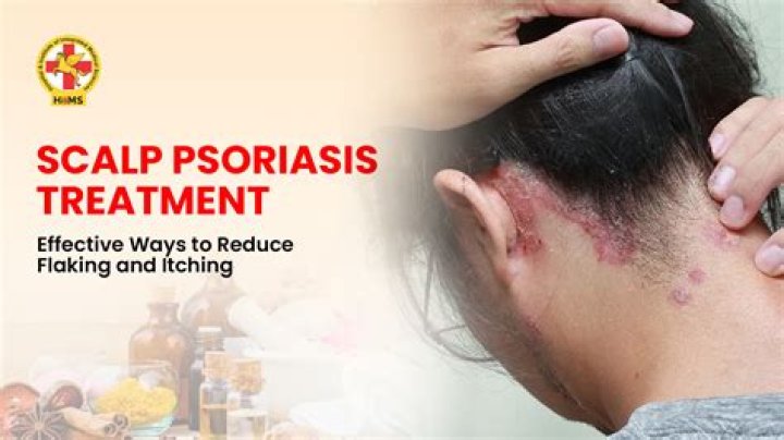 How do I get rid of scalp psoriasis?