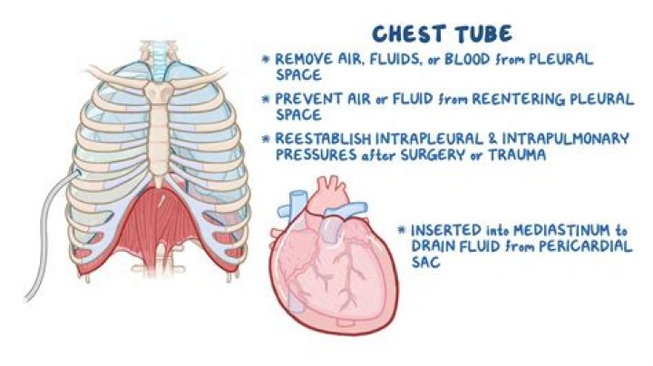 How do they put in a chest tube?