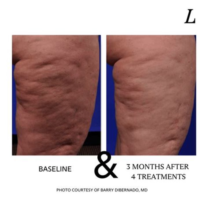 How do you eliminate cellulite?