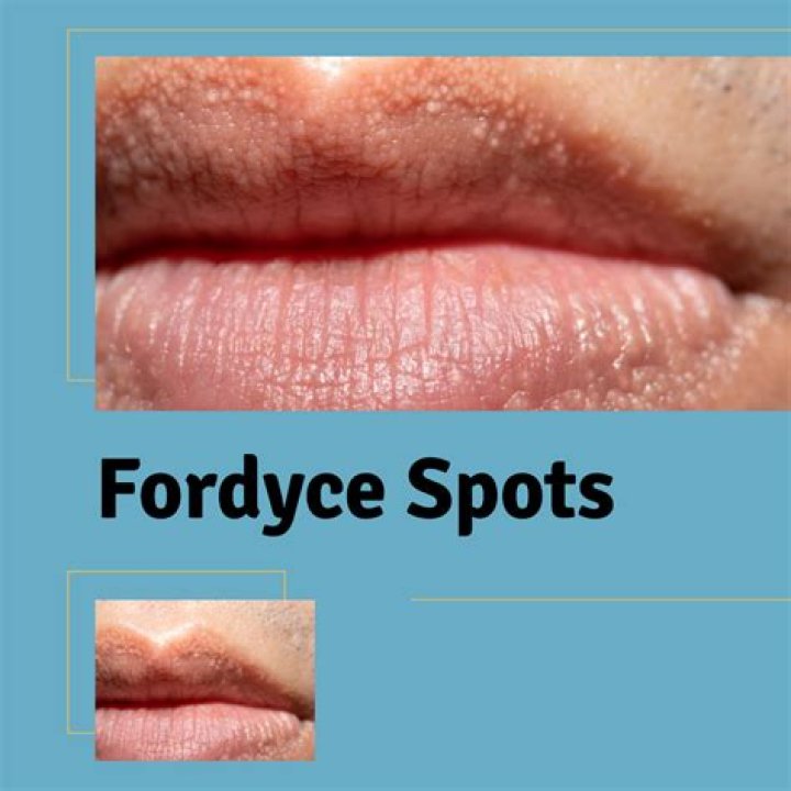 How do you get rid of Angiokeratoma of Fordyce?