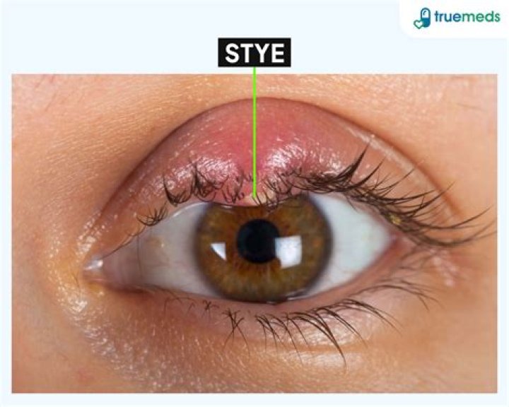 How do you know if a stye is getting better?