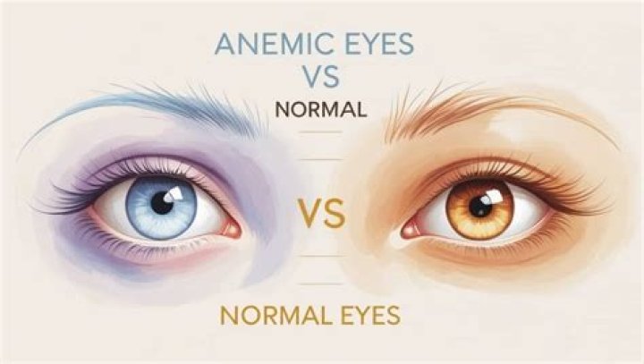 How does anemia affect eyes?