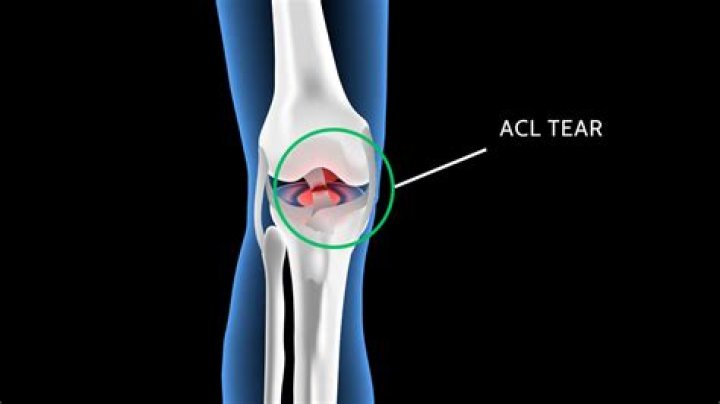 How likely are you to tear your ACL twice?