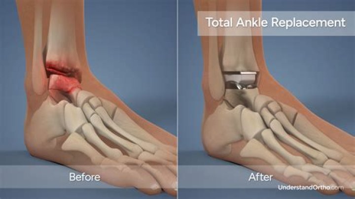 How long does ankle surgery take?