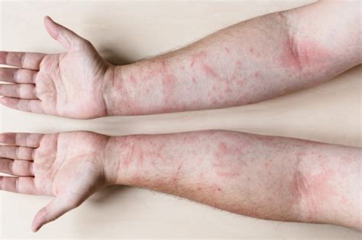 How long does it take for allergic contact dermatitis to go away?