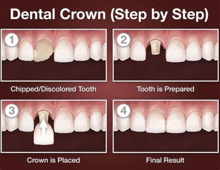 How long does it take to put on a crown?