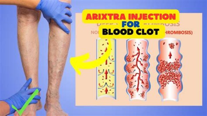 How long should Arixtra be held before surgery?