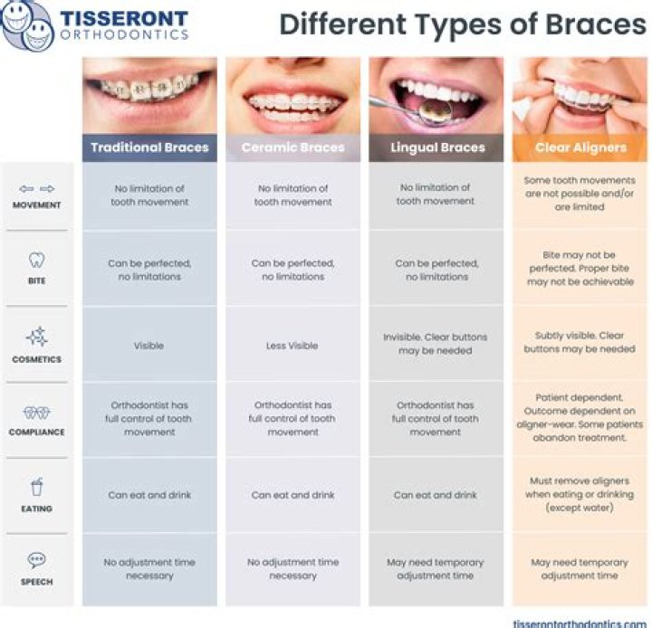 How many appointments until you get braces?
