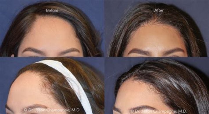 How much does a hairline lowering surgery cost?