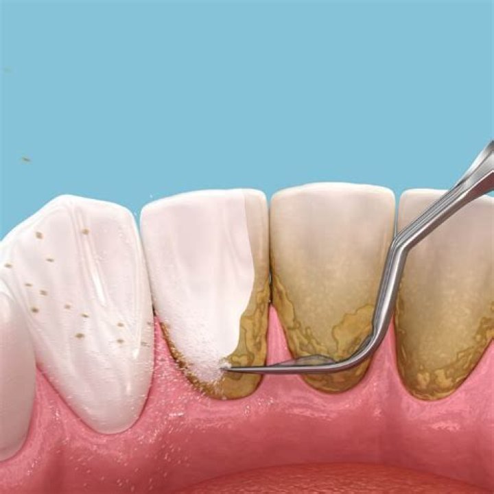 How much is a dental cleaning NYC?