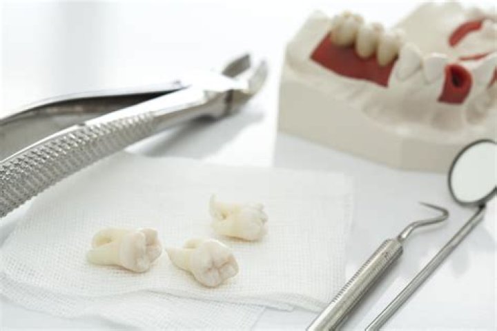 How should I prepare for wisdom teeth removal?