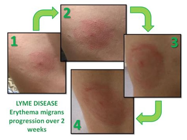 How soon do symptoms of Lyme disease appear?
