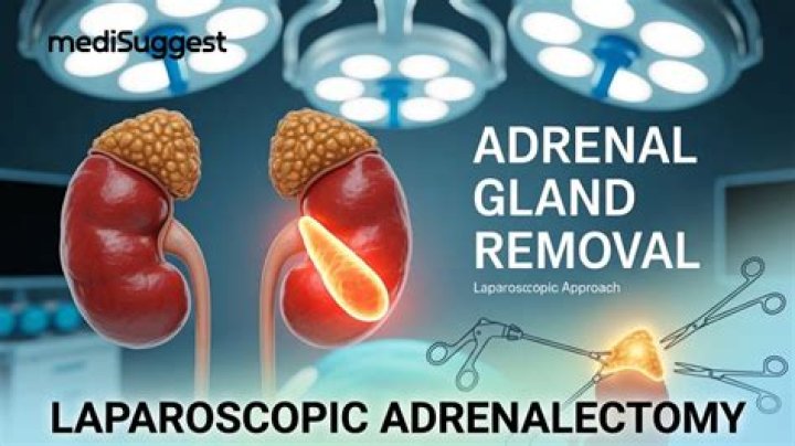 Is adrenalectomy major surgery? | ContextResponse.com