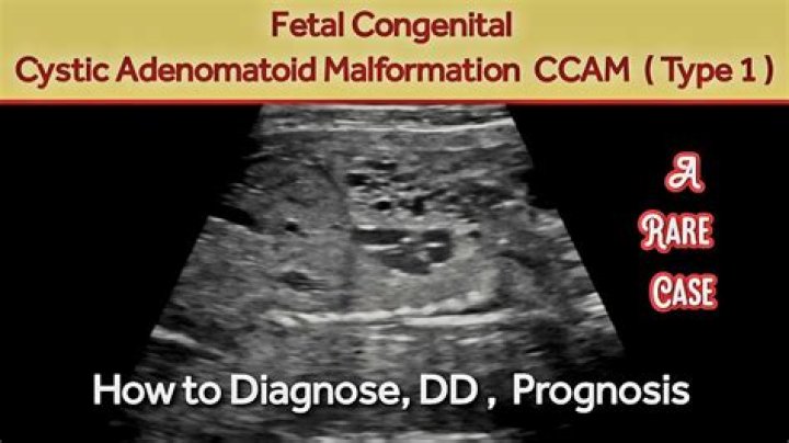 Is CCAM genetic? | ContextResponse.com