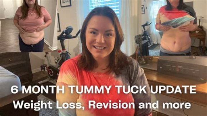 Is it easier to lose weight after a tummy tuck?