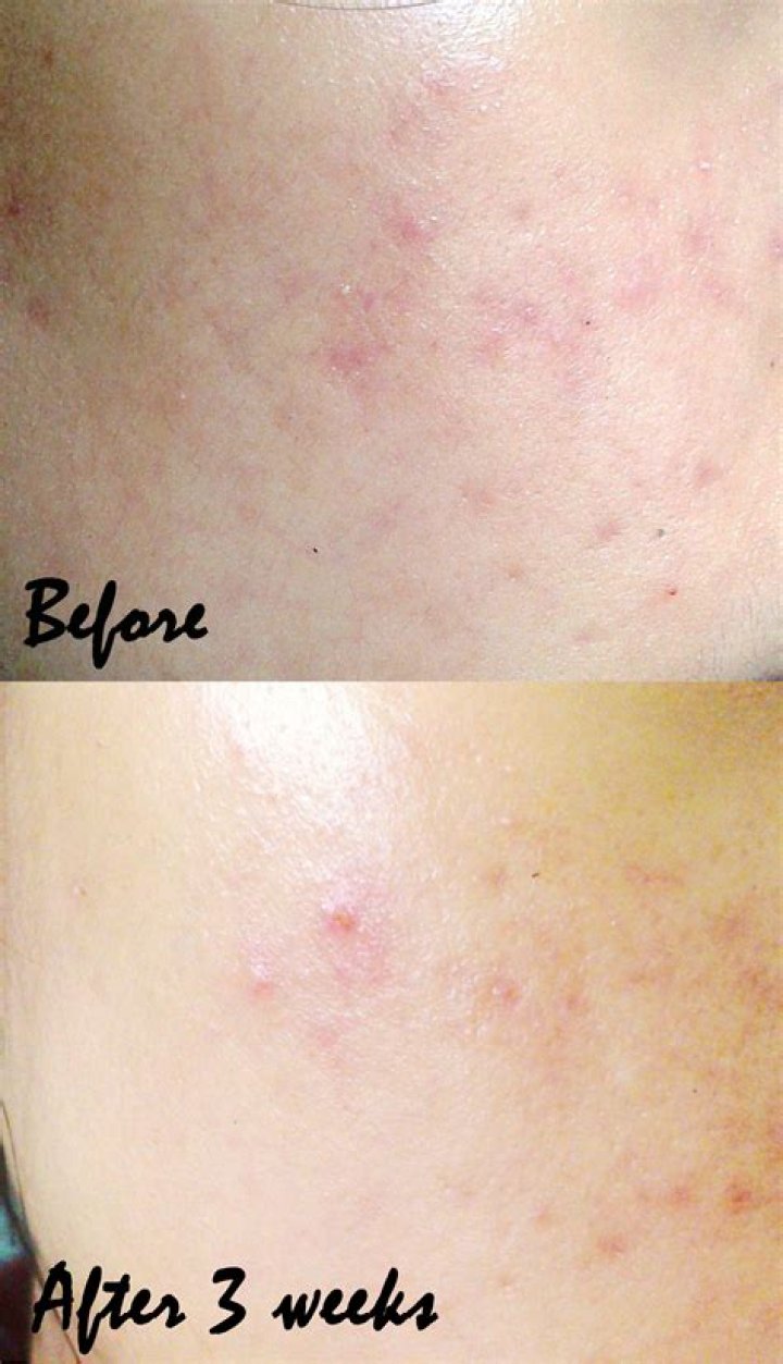 Is lemon good for acne treatment?