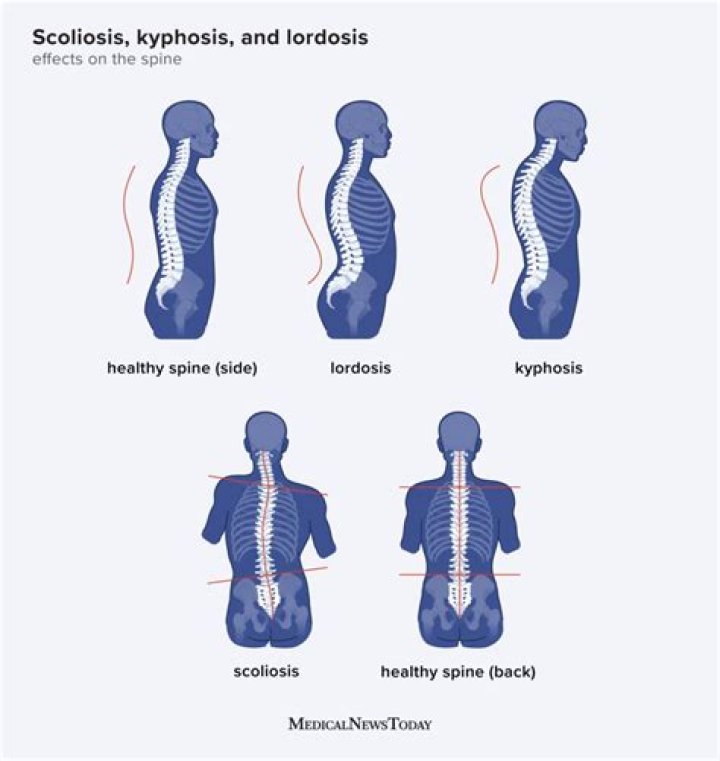 Is lordosis a form of scoliosis?