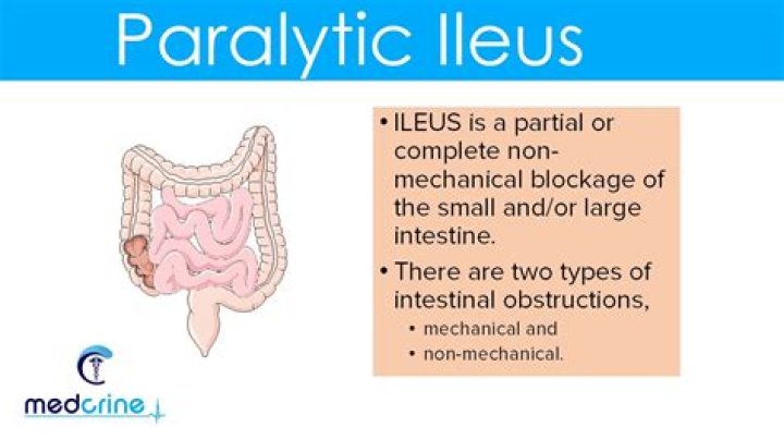 Is paralytic ileus painful? | ContextResponse.com