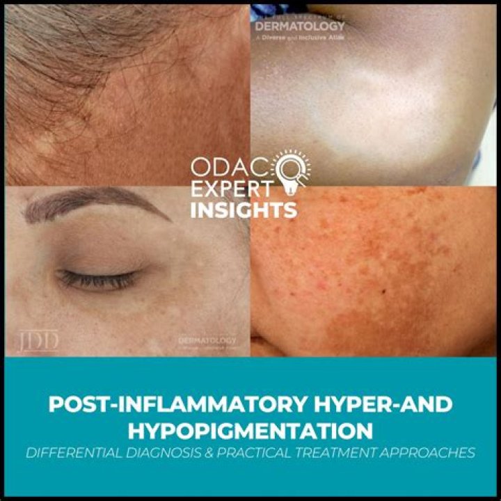 Is post inflammatory hypopigmentation permanent?