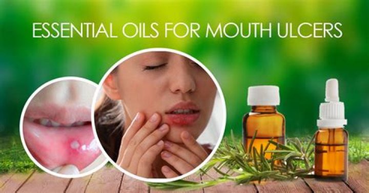 What's the best thing for mouth ulcers?