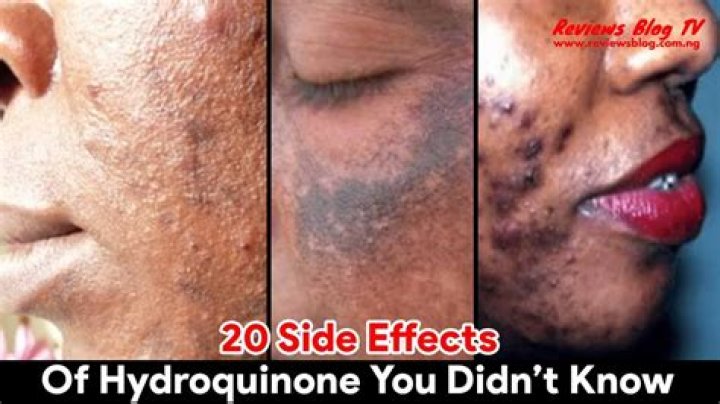 What are the side effects of hydroquinone?
