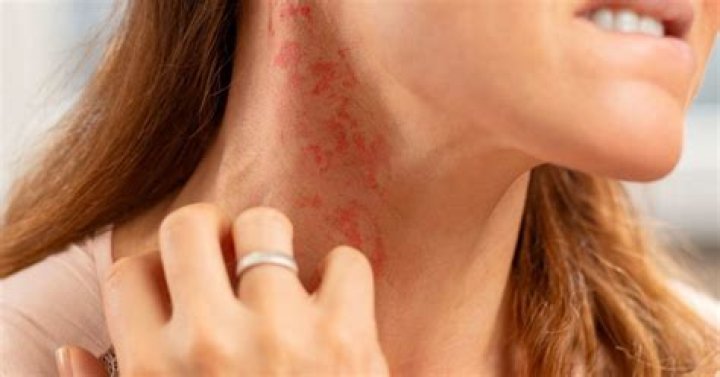 What causes itchy jawline?