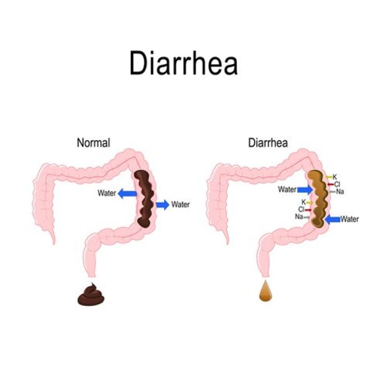 What diarrhea feels like? | ContextResponse.com