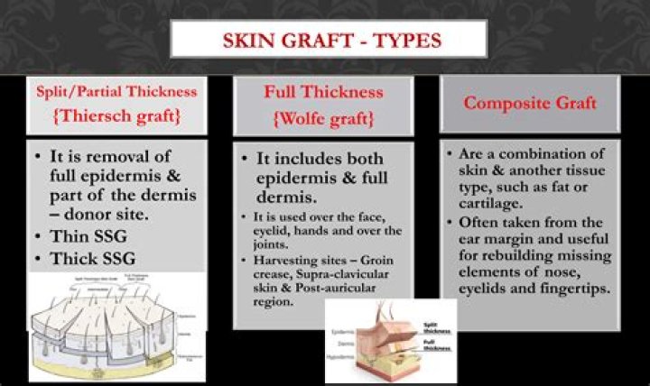 What is a TheraSkin graft?